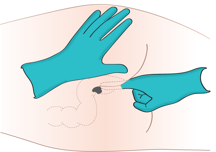 Illustration showing insertion of rectal suppository.