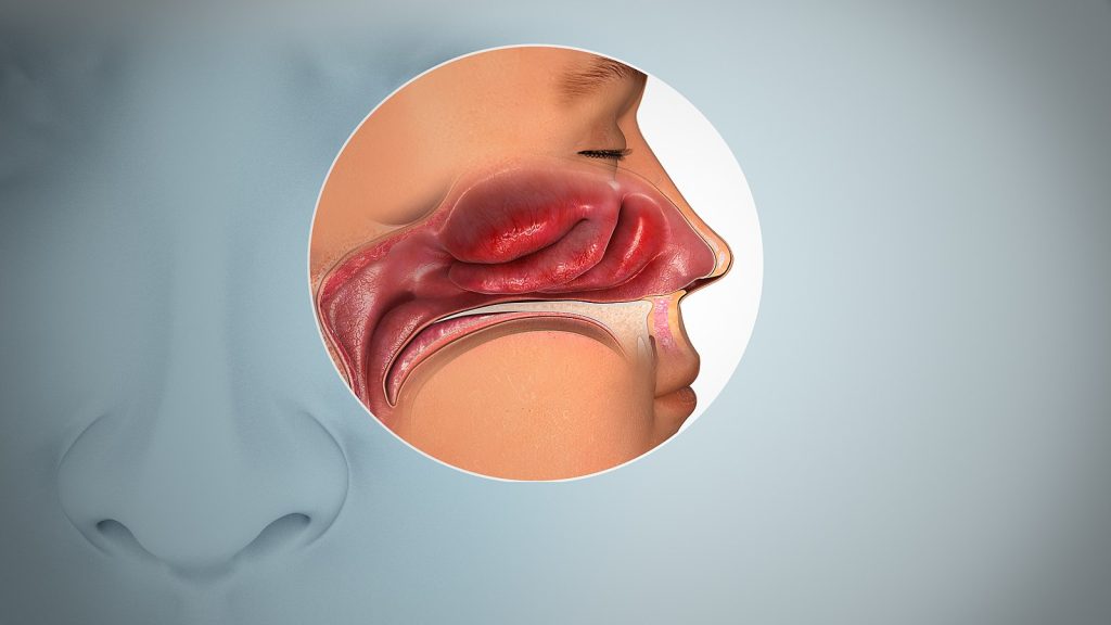 The image shows a cartoon of what inflamed nasal membranes look like. The image shows far more restricted air pathways.